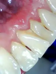 Médical Endoscope dentaire